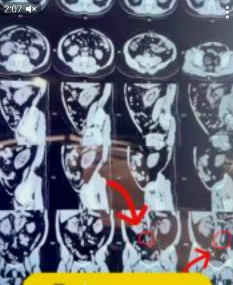 Respublika ixtisoslashtirilgan Urologiya ilmiy-amaliy tibbiyot markazi Qashqadaryo filialida  yana bir murakkab jarrohlik amaliyoti o’tkazildi